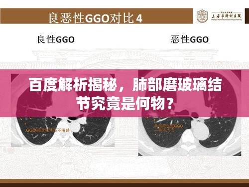 百度解析揭秘，肺部磨玻璃結(jié)節(jié)究竟是何物？